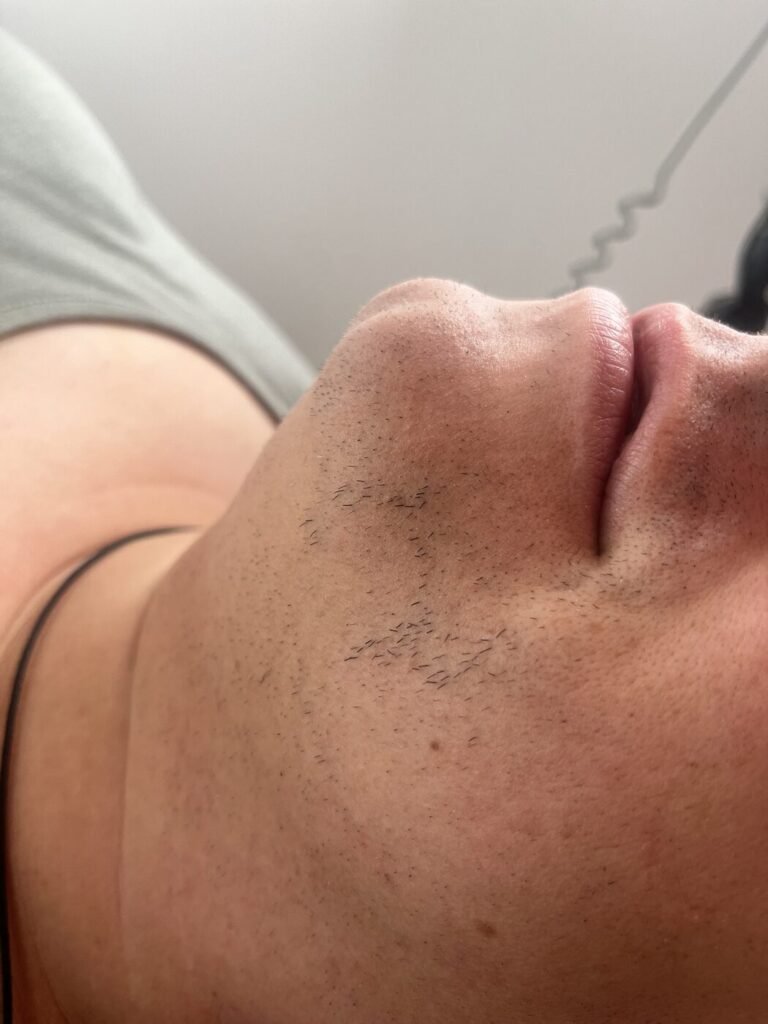 The same area after one laser session, with only sparse hair remaining