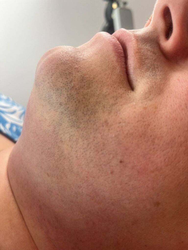 Close-up of a client's chin and jaw showing dense beard shadow before laser hair removal