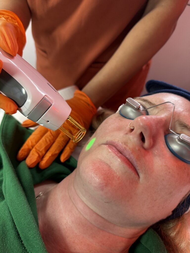 Vanessa Hill carrying out facial laser hair removal in her private Worcester clinic